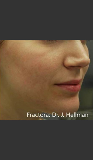 After Photo for Fractora #1 -  - Prejuvenation