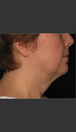 After Photo for Treatment of Neck with Laser Liposuction -  - Prejuvenation