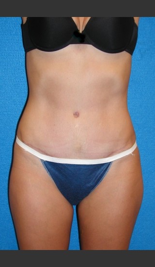 After Photo for Tummy Tuck Case #2 - South Coast Plastic Surgery - Prejuvenation