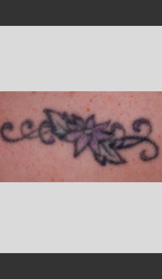 Before Photo for PicoWay.Picosecond Technology Tattoo Removal -  - Prejuvenation