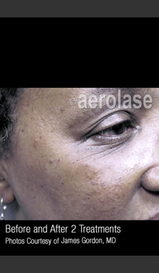 Before Photo for Facial Pigmentation & Texture #325 -  - Prejuvenation