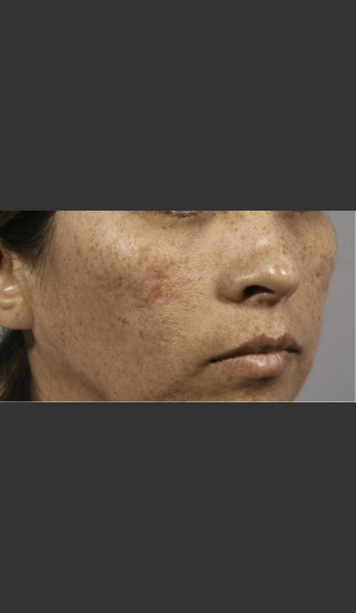 After Photo for 3DEEP Intensif Microneedling #1 -  - Prejuvenation