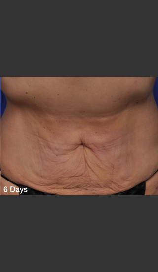 After Photo for ThermiTight Treatment - Barry E. DiBernardo, MD, FACS - Prejuvenation