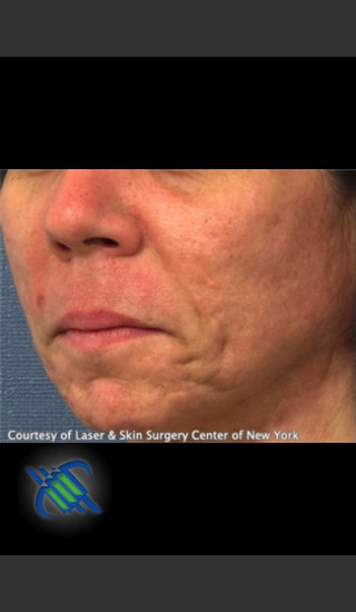Before Photo for Treatment of Lower Face Acne Scarring - Roy G. Geronemus, M.D. - Prejuvenation