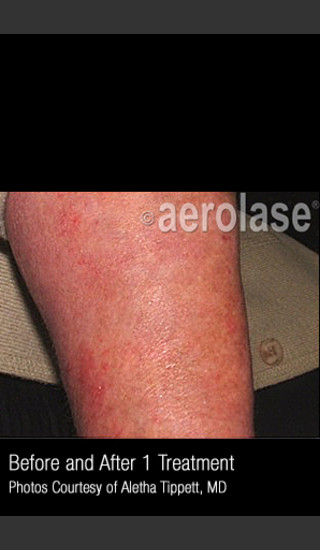 After Photo for Treatment of Psoriasis #334 -  - Prejuvenation