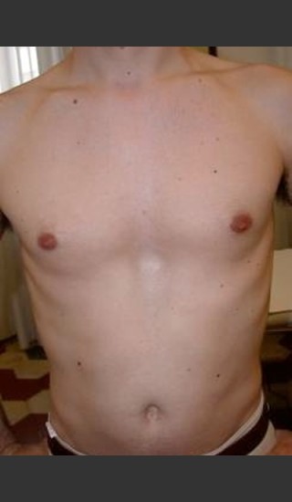 After Photo for Quanta Light Series Laser Hair Removal #74 -  - Prejuvenation