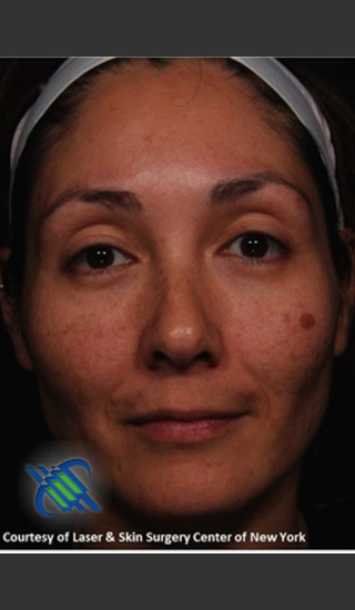 Before Photo for Full Face Treatment with Fraxel - Roy G. Geronemus, M.D. - Prejuvenation