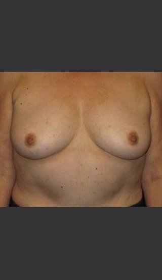 Before Photo for Breast Augmentation  - Robert Aycock - Prejuvenation