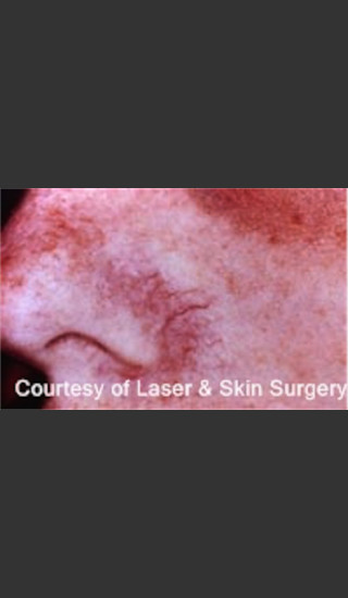 Before Photo for Treatment of Facial Blood Vessels -  - Prejuvenation