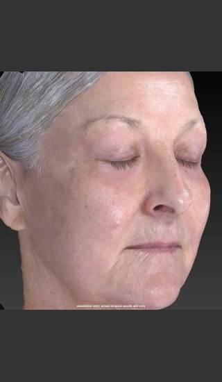 After Photo for Deep Wrinkle Reduction - Douglas Wu, M.D. - Prejuvenation