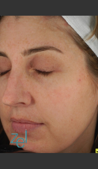 After Photo for Full Face Treatment of Skin Pigmentation - Brian D. Zelickson, M.D. - Prejuvenation