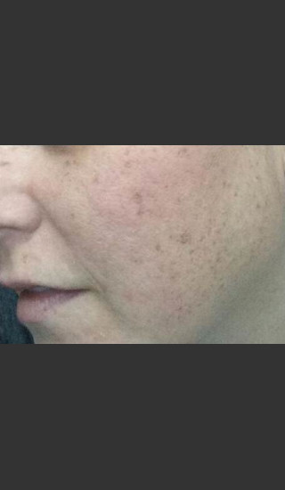 Before Photo for Lumecca Intense Pulsed Light #2 -  - Prejuvenation