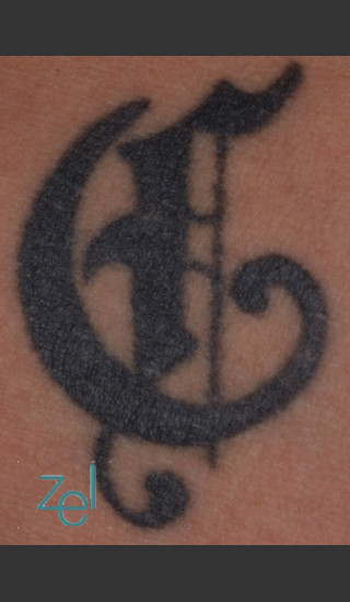 Before Photo for Treatment of Symbol Tattoo - Brian D. Zelickson, M.D. - Prejuvenation
