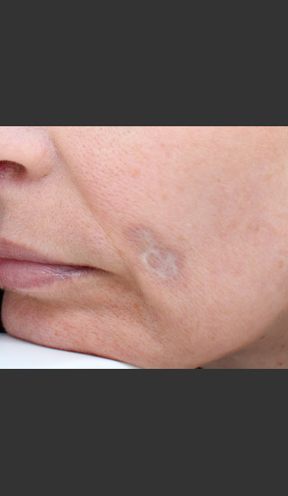 Before Photo for Traumatic scar  - Paul M. Friedman, M.D. - Prejuvenation