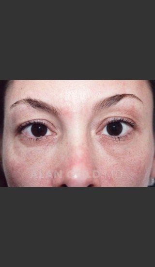 Before Photo for Blepharoplasty 871 - Alan Gold MD - Prejuvenation