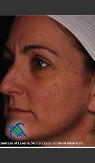After Photo for Left Side Full Face Skin Rejuvenation - Roy G. Geronemus, M.D. - Prejuvenation