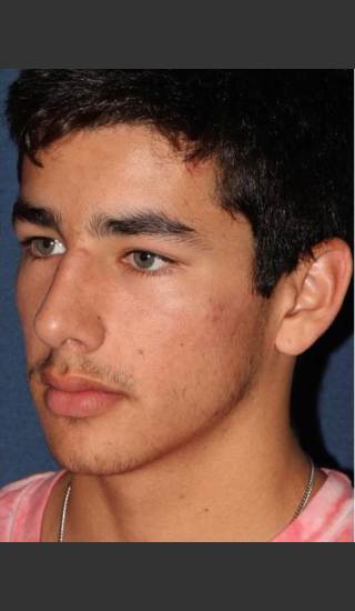 After Photo for Treatment of Acne  - Mitchel P. Goldman M.D. - Prejuvenation