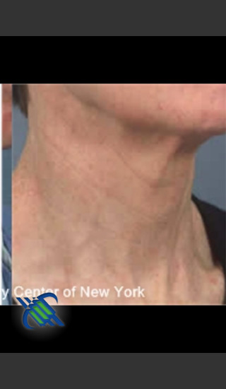 After Photo for Treatment of Neck Pigmentation - Roy G. Geronemus, M.D. - Prejuvenation