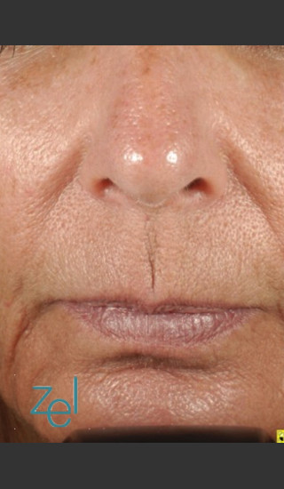 After Photo for Treatment of Peri-Oral Lines and Wrinkles - Brian D. Zelickson, M.D. - Prejuvenation