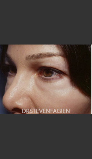 Before Photo for Periorbital Rejuvenation - Patient 7 - Steven Fagien, MD - Prejuvenation
