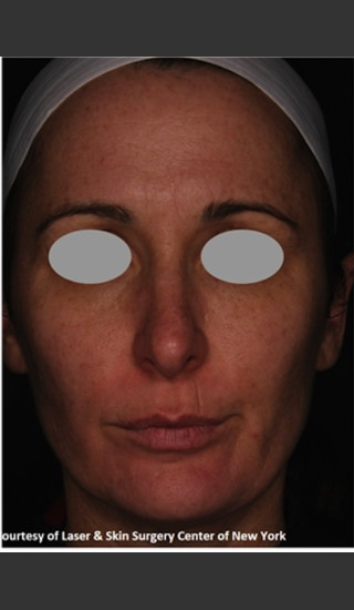 After Photo for Full face Treament with Fraxel - Roy G. Geronemus, M.D. - Prejuvenation