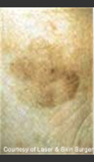 Before Photo for Treatment of Facial Pigmentation -  - Prejuvenation