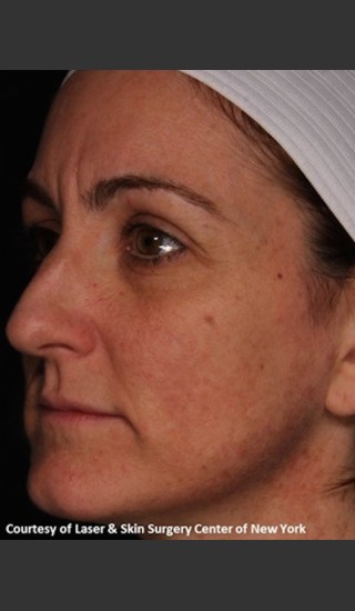 After Photo for Full Face Rejuvenation with Fraxel Dual - Roy G. Geronemus, M.D. - Prejuvenation