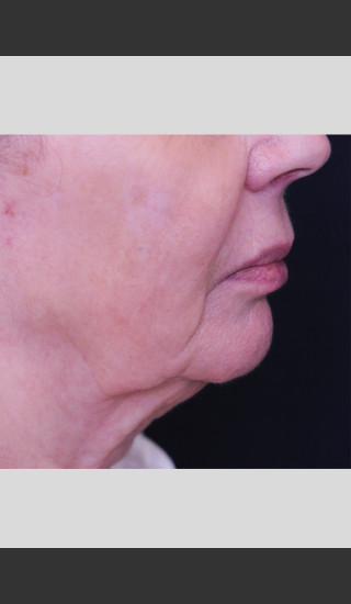 After Photo for Profound Lift Treatment of Jawline -  - Prejuvenation