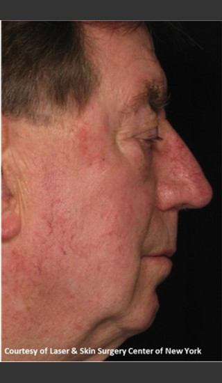 After Photo for Full face Treament with Fraxel - Roy G. Geronemus, M.D. - Prejuvenation