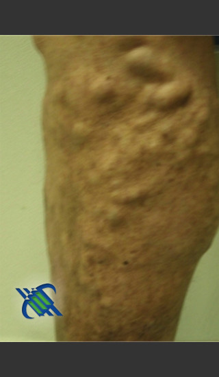 Before Photo for Treatment of Lower Leg Veins - Roy G. Geronemus, M.D. - Prejuvenation