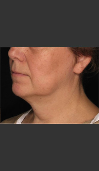 After Photo for Treatment of Neck Contour -  - Prejuvenation