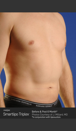 Before Photo for Smartlipo High Def Laser Lipo -  - Prejuvenation
