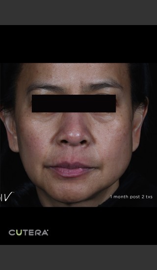 After Photo for Pigmented Removal Before & After Photo Front On Full Face -  - Prejuvenation