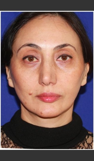 After Photo for Facelift - Case 23 - Konstantin Vasyukevich, MD - Prejuvenation