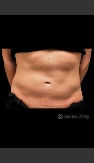 Before Photo for CoolSculpting Before & After on Woman -  - Prejuvenation