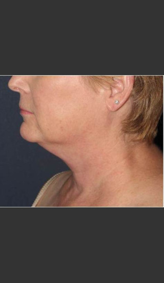 Before Photo for Facial Liposculpture - William F. Groff, M.D. - Prejuvenation