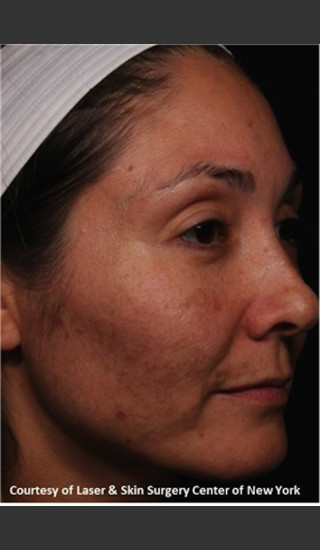 Before Photo for Treatment of Melasma -  - Prejuvenation