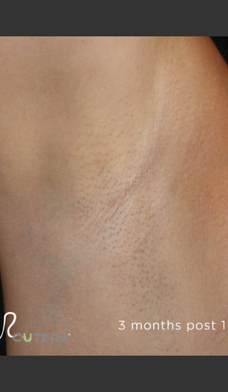 After Photo for Hair Removal of Under Arms With Excel HR -  - Prejuvenation