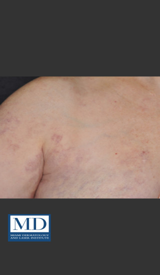 After Photo for Port Wine Stain Treatment 104 - Jill S. Waibel, MD - Prejuvenation