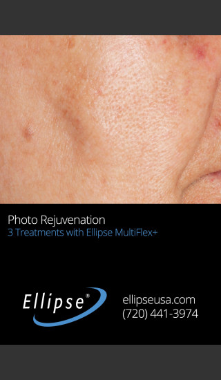 After Photo for Full Face Rejuvenation after 3 Treatments  -  - Prejuvenation