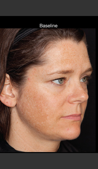 Before Photo for Hyperpigmentation - Professional Peel - Brian S. Biesman, MD - Prejuvenation