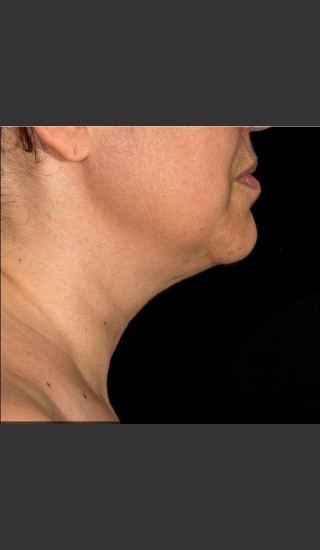 After Photo for SculpSure Submental - Bruce E Katz, M.D. - Prejuvenation