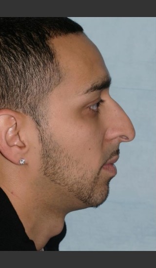 Before Photo for Rhinoplasty - Case 17 - Konstantin Vasyukevich, MD - Prejuvenation
