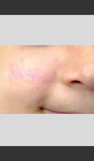 After Photo for Vbeam. Pulsed Dye Laser treatment of Scars -  - Prejuvenation