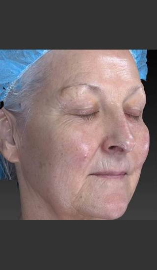 Before Photo for Deep Wrinkle Reduction - Douglas Wu, M.D. - Prejuvenation