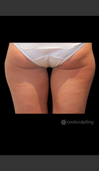 Before Photo for CoolSculpting Before & After on Woman -  - Prejuvenation