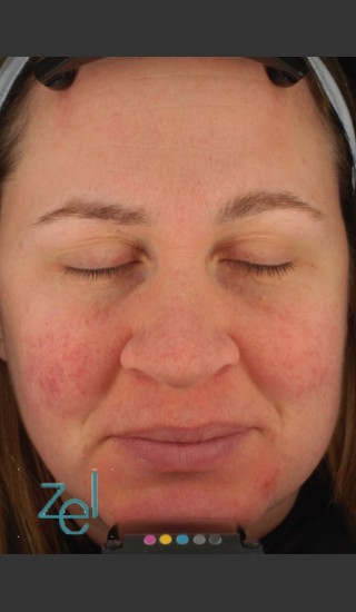 After Photo for Treatment of Facial Redness  - Brian D. Zelickson, M.D. - Prejuvenation
