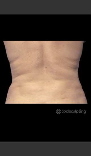 After Photo for CoolSculpting Before & After on Woman -  - Prejuvenation
