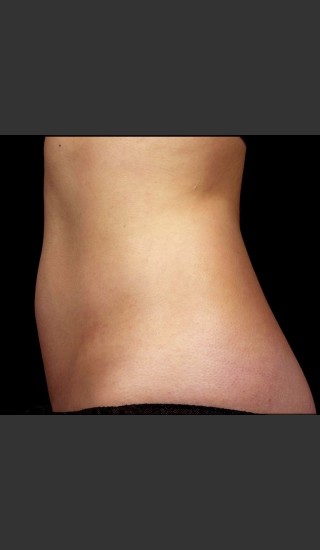After Photo for SculpSure Abdomen - Bruce E Katz, M.D. - Prejuvenation