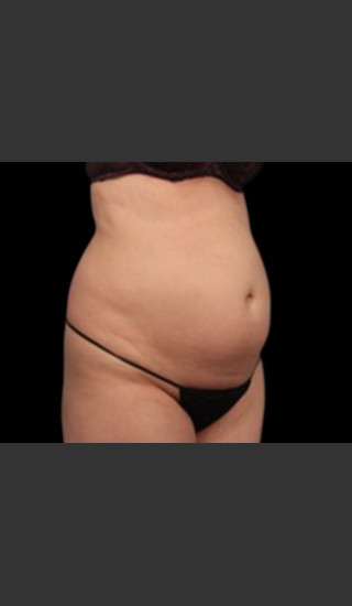 Before Photo for Body Contouring Treatment #119 -  - Prejuvenation